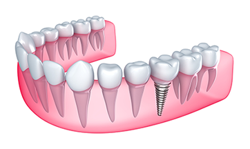 Dental Implants in Mokena, IL