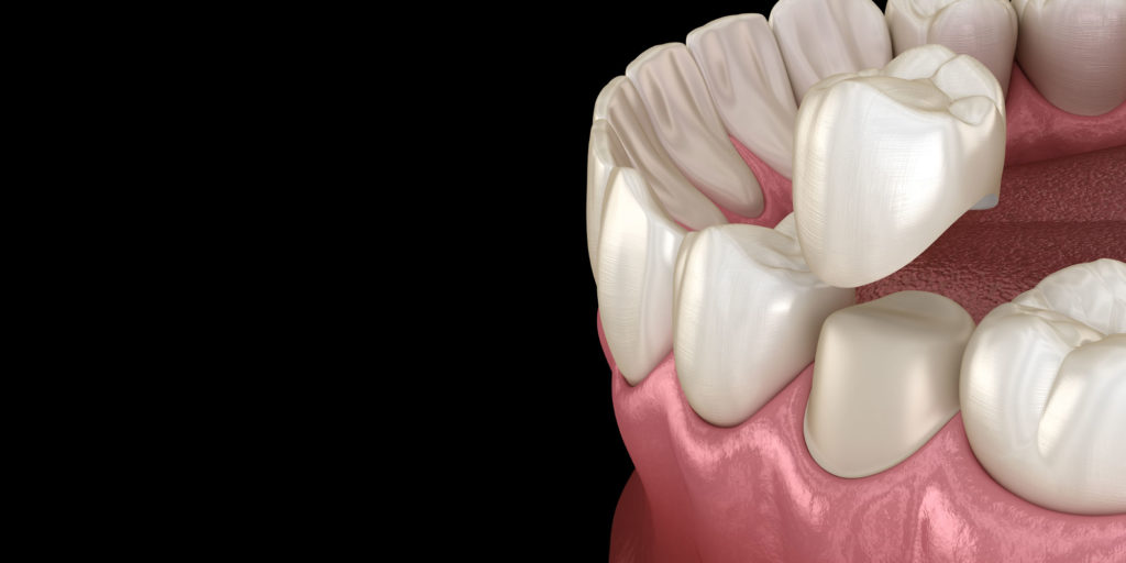 dental crown model