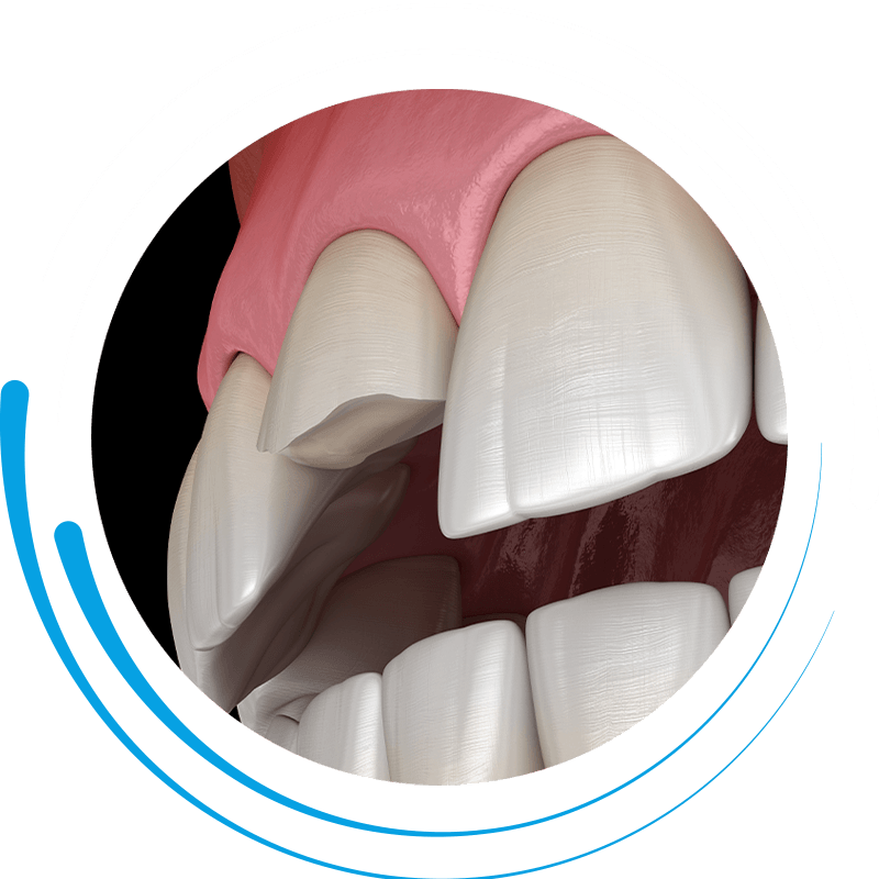 chipped tooth 1