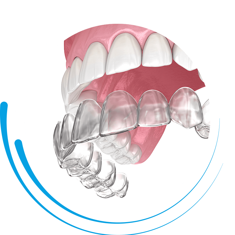 clear aligner 3d