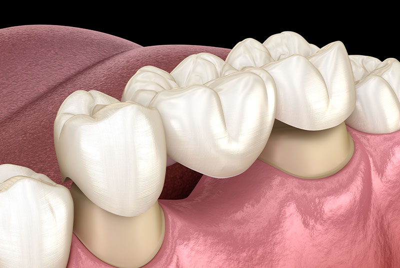 dental bridge 5050