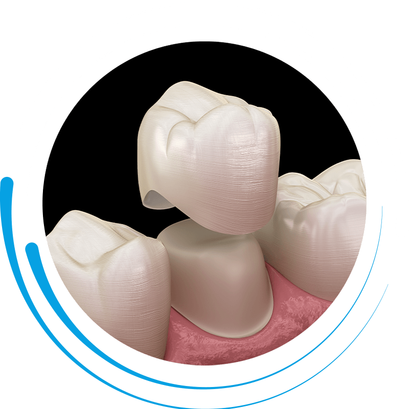 dental crown cir