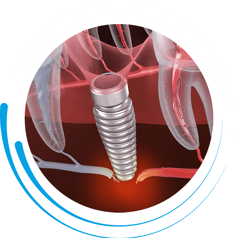 implant failure