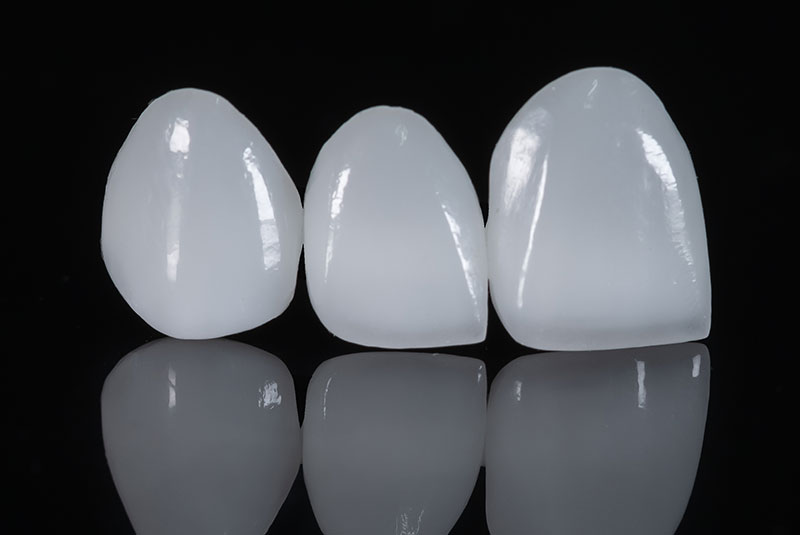 porcelain veneer blk