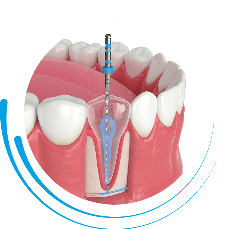 root canal procedure
