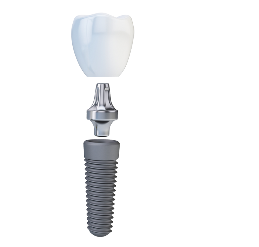 implant3partsyoung