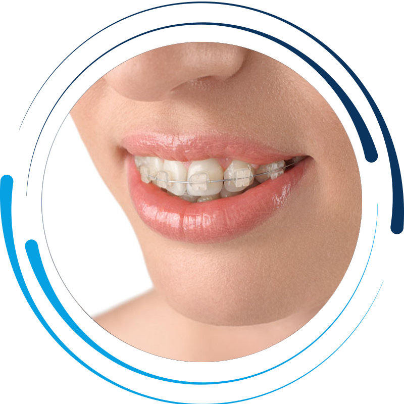 braces-circle