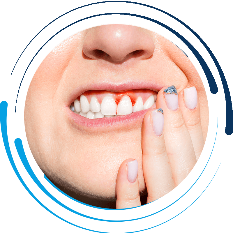 gingivitis