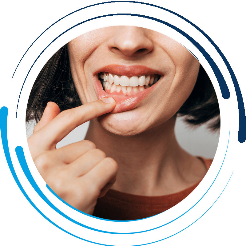 periodontitis