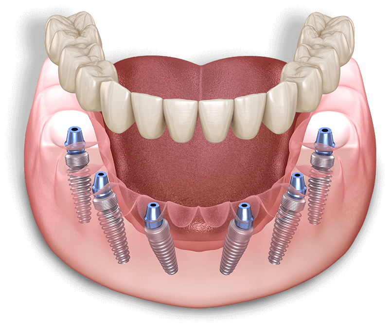 dental implant model